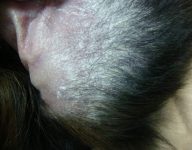 13a - Dermatitis descamativa en la parte interna y distal de los pabellones auriculares en un perro con leishmaniosis.